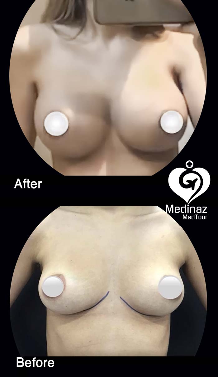 breast augmentation before and after photo 