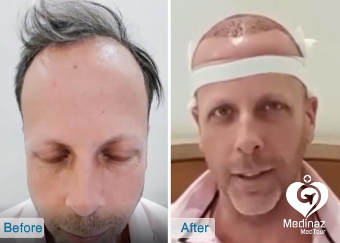 Hair transplant before and after photo 