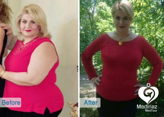 ٌWeight Loss Surgery before and after photo 