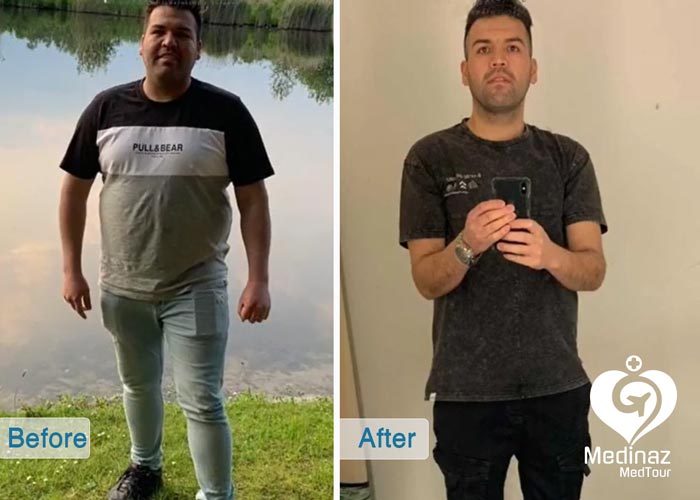 ٌWeight Loss Surgery before and after photo 