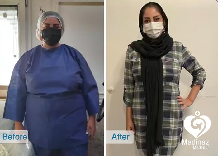 ٌWeight Loss Surgery before and after photo 