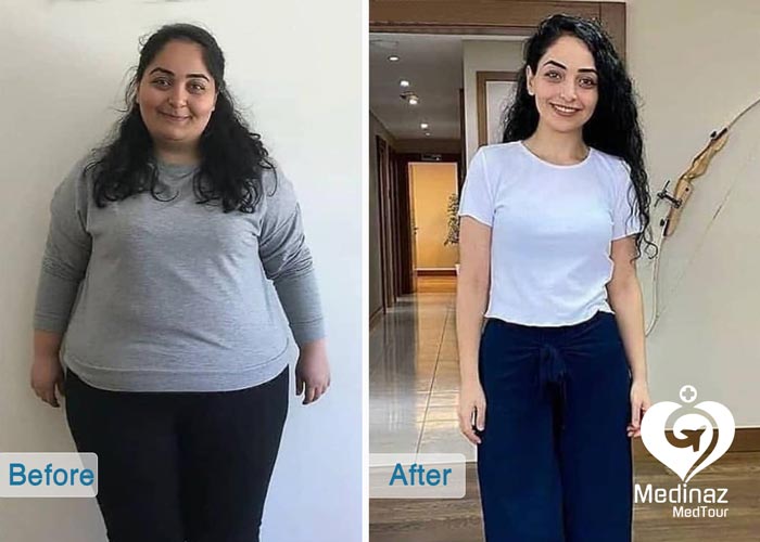 ٌWeight Loss Surgery before and after photo 