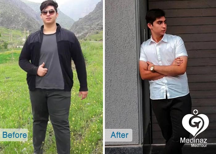 ٌWeight Loss Surgery before and after photo 